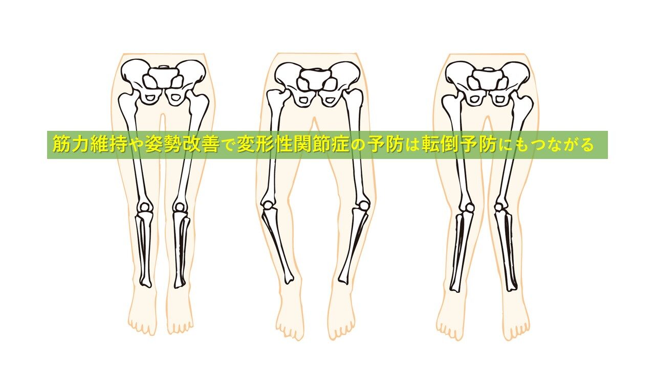 “転倒“につながる変形性関節症